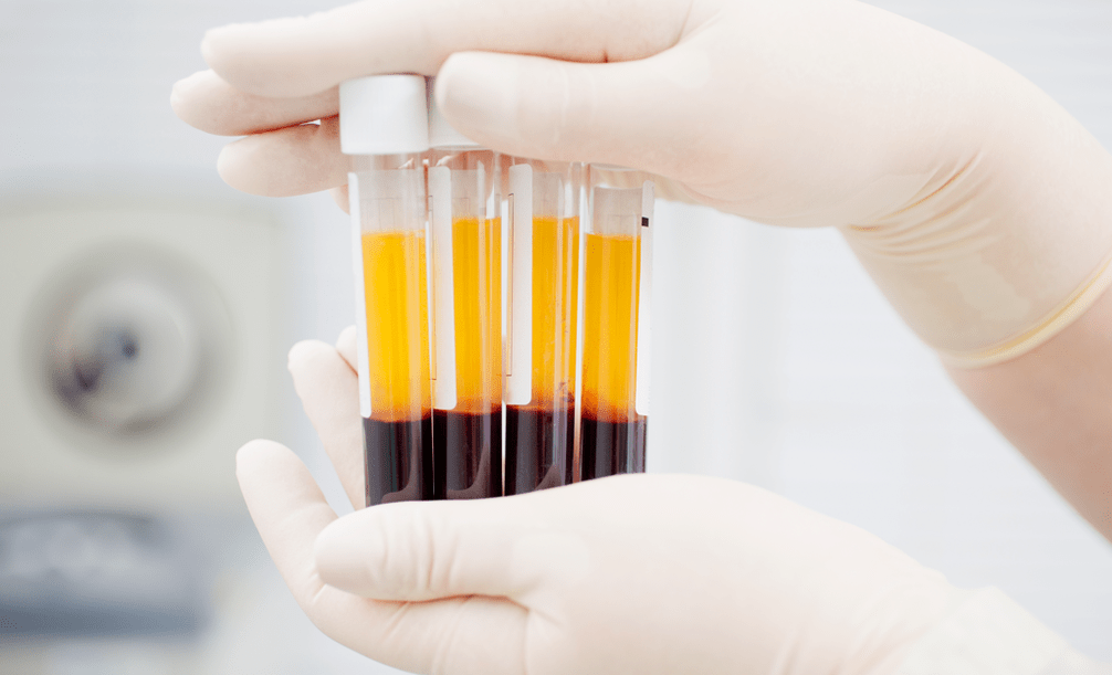 البلازما الغنية بالصفائح الدموية لعلاج التهاب المفاصل PRP